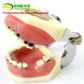 VENDER 12610 Modelo de mandíbula grave para entrenamiento de cirugía periodontal